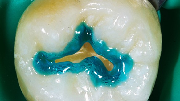 Gel condizionatore per denti