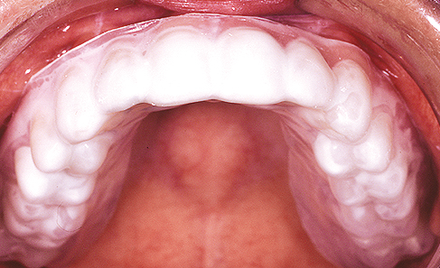 Fermo per apparecchio dentale 1 pezzo
