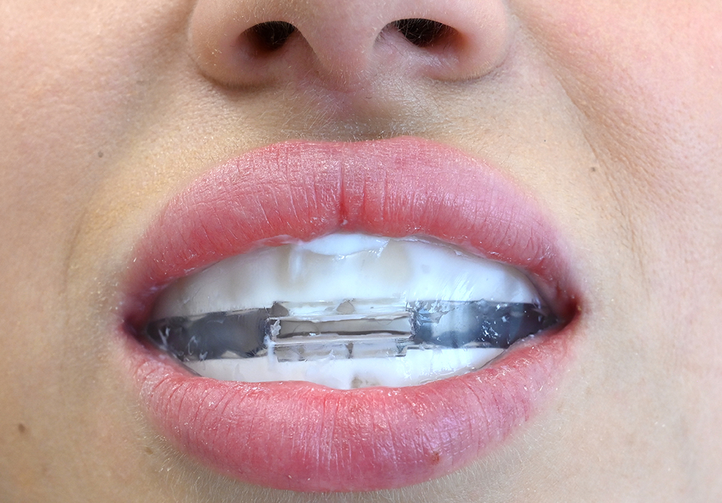 Set per la remineralizzazione e MIH (denti di gesso)